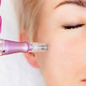 Microneedling